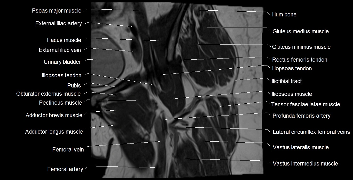 MRI Hip 3T coronal cross sectional anatomy image 18.webp